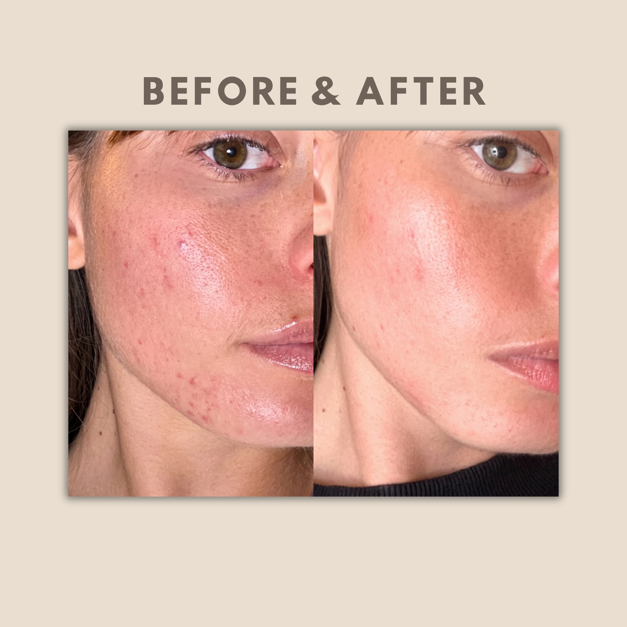 LED Skin Rejuvenation Face Mask